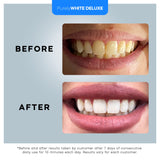 Teeth Whitening Kit